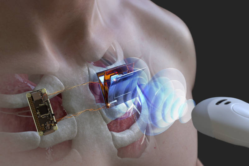 초음파 프로브를 이용해 신체 삽입형 전자기기의 구동을 위한 전력을 무선충전하는 아이디어 개념도